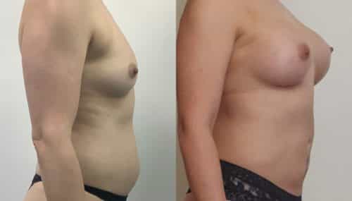 breast augmentation colombia 366-5-min