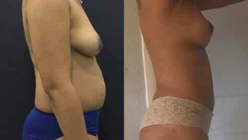 breast lift colombia 201-3-min