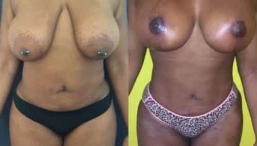 breast lift colombia 206-1-min