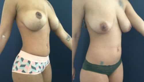 breast lift colombia 207-4-min