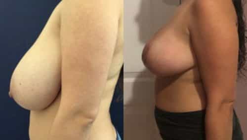 breast lift colombia 224-3-min