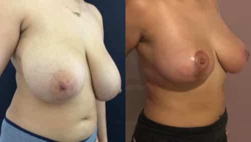 breast lift colombia 224-4-min