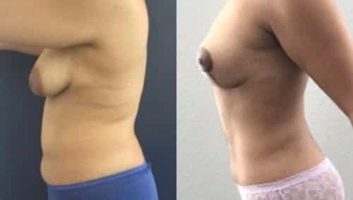 breast lift colombia 244-2-min