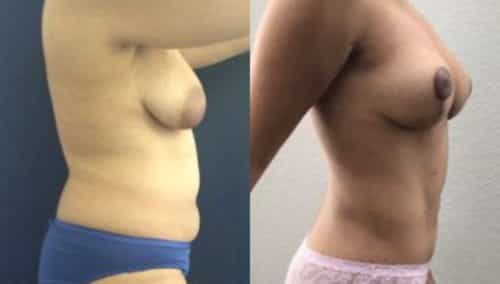 breast lift colombia 244-3-min