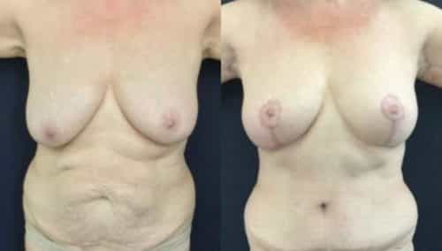 breast lift colombia 246-1-min