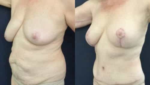 breast lift colombia 246-2-min