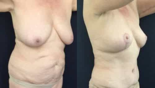 breast lift colombia 246-4-min