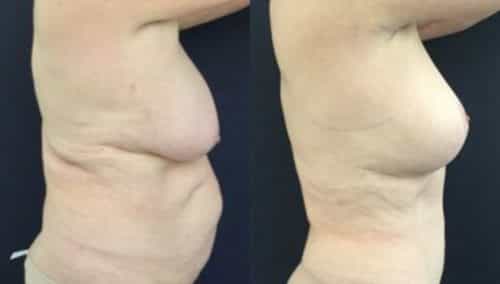 breast lift colombia 246-5-min