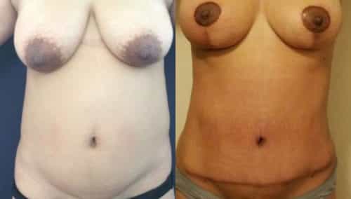 breast lift colombia 247-1-min
