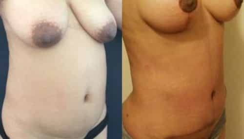 breast lift colombia 247-4-min