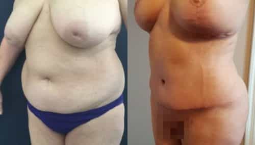 breast lift colombia 252-2-min