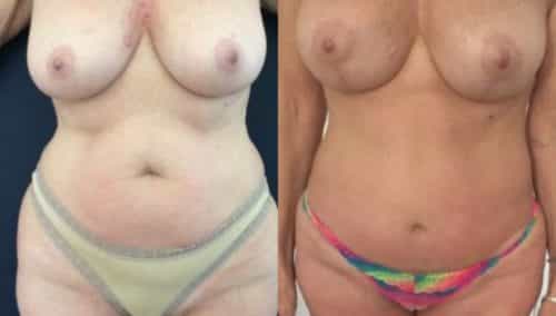 breast lift colombia 274-1-min