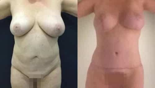breast lift colombia 282-1-min