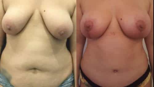 breast lift colombia 288-1-min