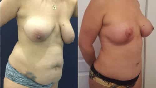 breast lift colombia 288-4-min