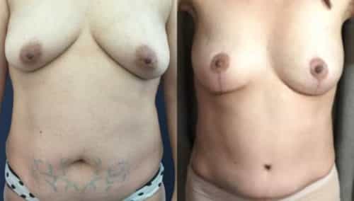 breast lift colombia 293-1-min
