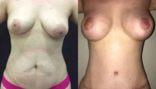 breast lift colombia 297 -1-min