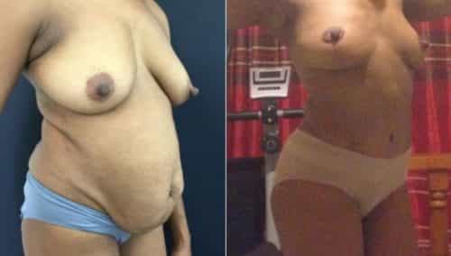 breast lift colombia 299-4-min