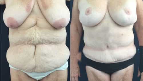 breast lift colombia 322-1-min