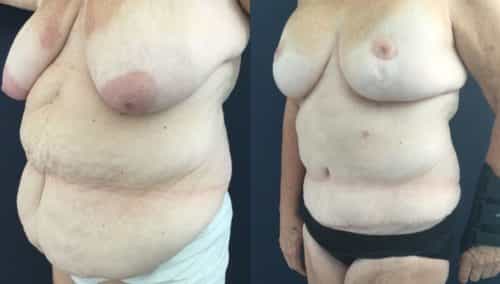 breast lift colombia 322-2-min