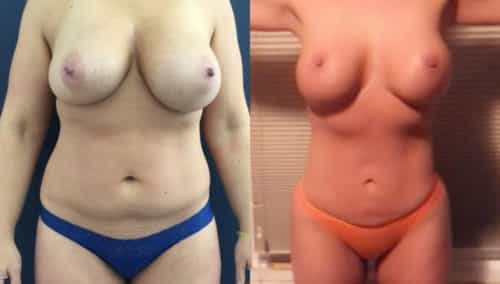 breast lift colombia 327 - 1-min