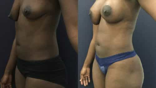 breast lift colombia 343-1-min
