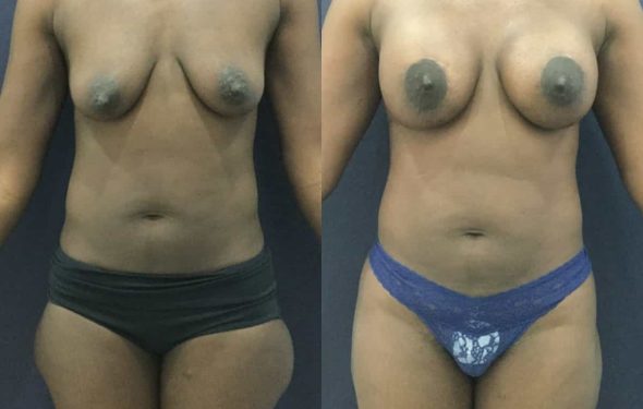 breast lift colombia 343 - 1-min breast lift with implants