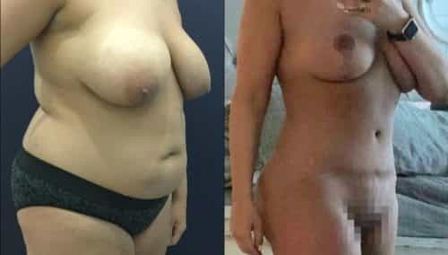 breast lift colombia 349-1-min