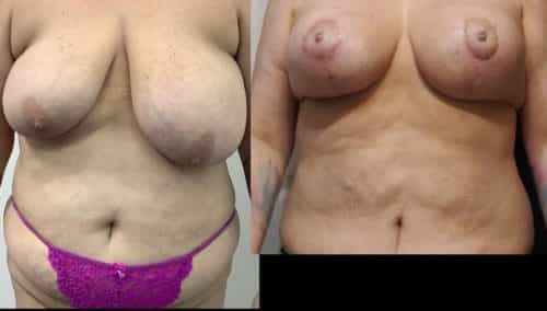breast lift colombia 351-1-min