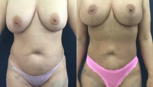 breast lift colombia 358 - 1-min