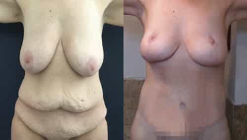 breast lift colombia 389-1-min
