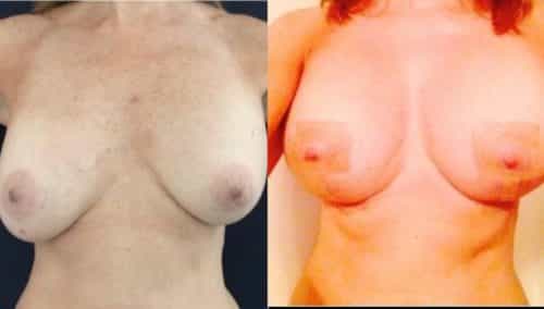 breast revision colombia 236 - 1