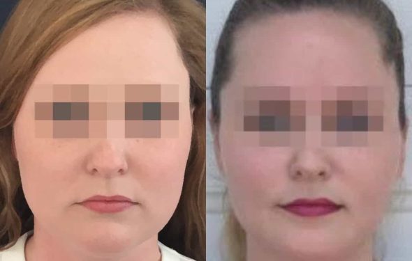 buccal fat pad excision Colombia 203 - 1-min