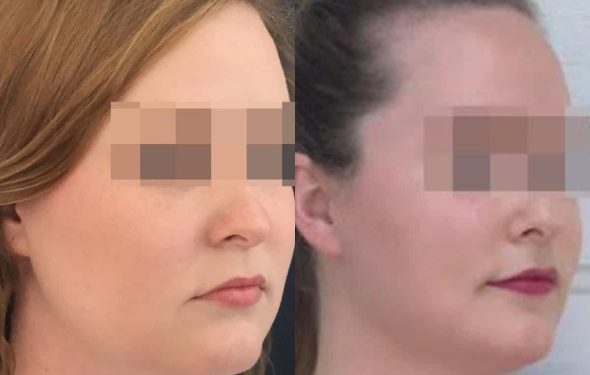 buccal fat pad excision Colombia 203 - 2-min