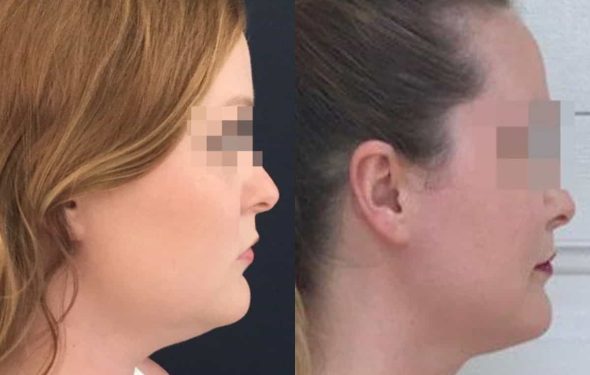 buccal fat pad excision Colombia 203 - 3-min