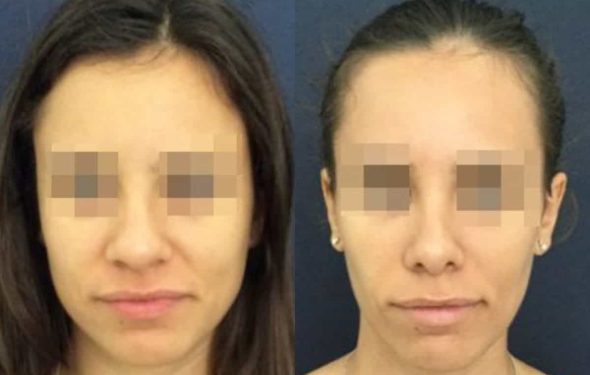 buccal fat pad excision Colombia 212 - 1-min