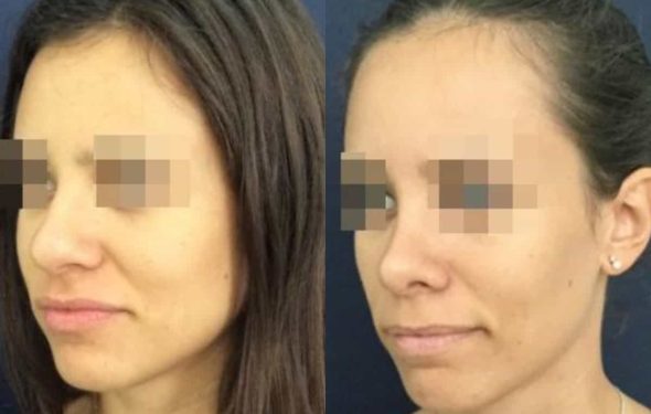 buccal fat pad excision Colombia 212 - 2-min