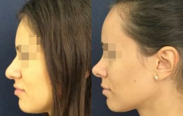 buccal fat pad excision Colombia 212 - 3-min
