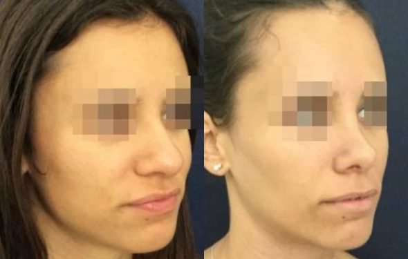 buccal fat pad excision Colombia 212 - 4-min