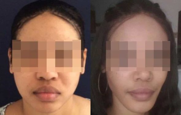 buccal fat pad excision Colombia 267 - 1-min