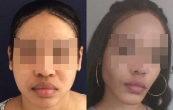 buccal fat pad excision Colombia 267 - 2-min