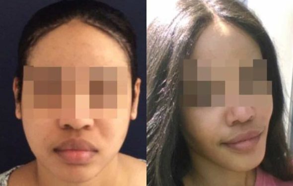 buccal fat pad excision Colombia 267 - 3-min