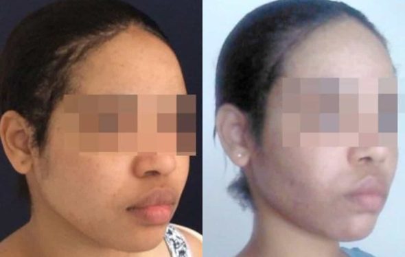 buccal fat pad excision Colombia 267 - 4-min