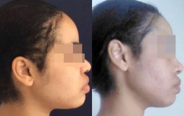 buccal fat pad excision Colombia 267 - 5-min