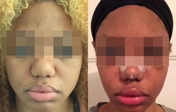 buccal fat pad excision Colombia 317 - 1-min