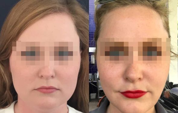 buccal fat pad excision Colombia 333 - 1-min