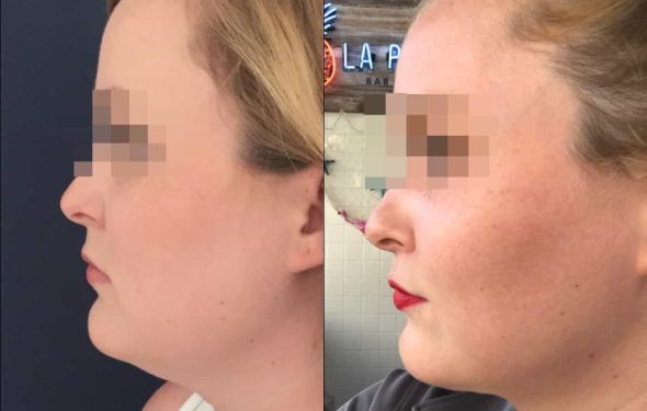 buccal fat pad excision Colombia 333 - 2-min