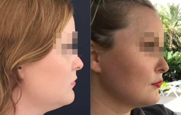 buccal fat pad excision Colombia 333 - 3-min