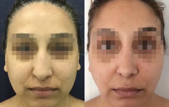 buccal fat pad excision Colombia 342 - 1-min