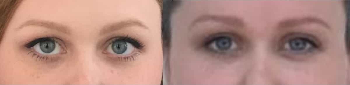 close up before and after photos highlighting the effects of eyelid surgery